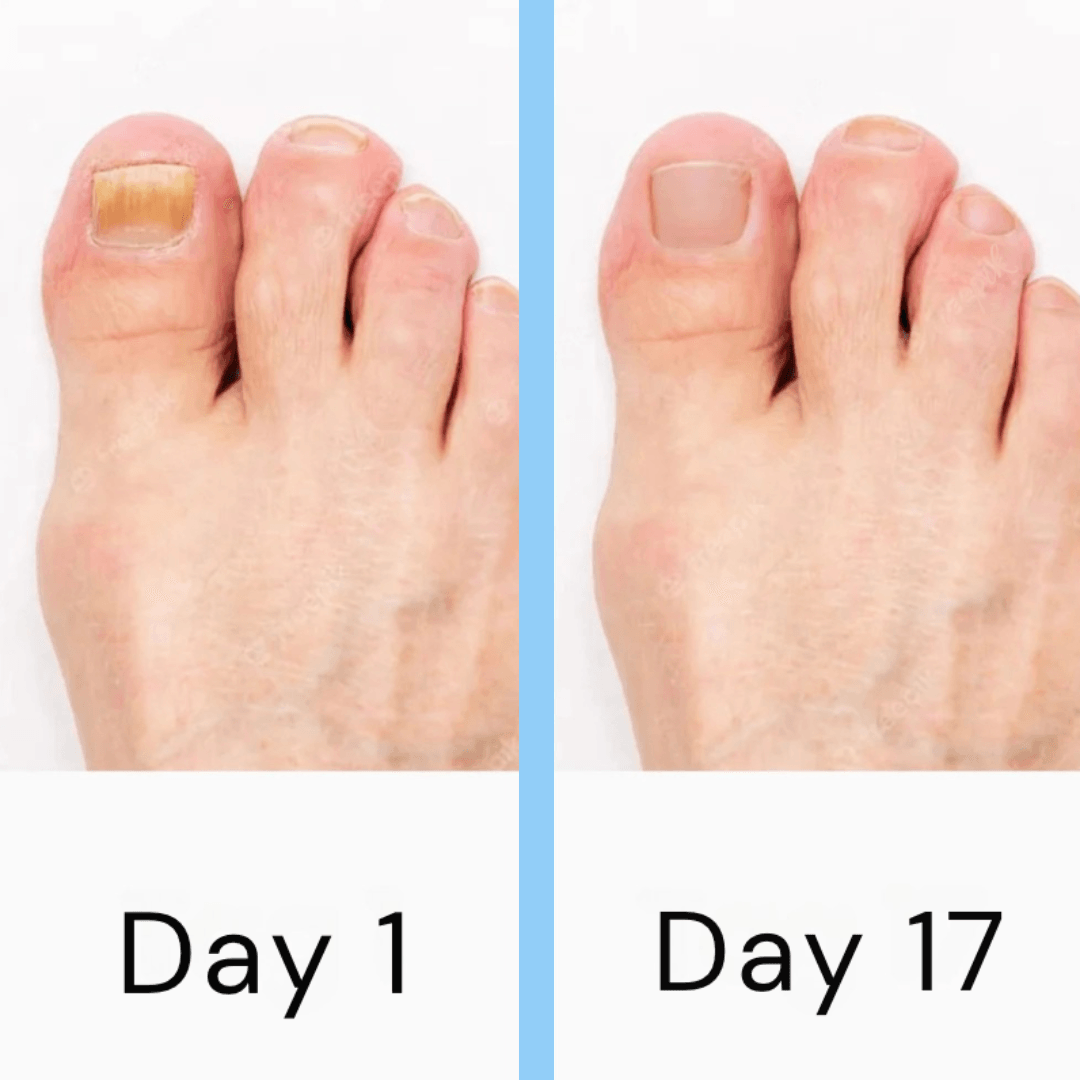 Nail Laser Fungus Device 4