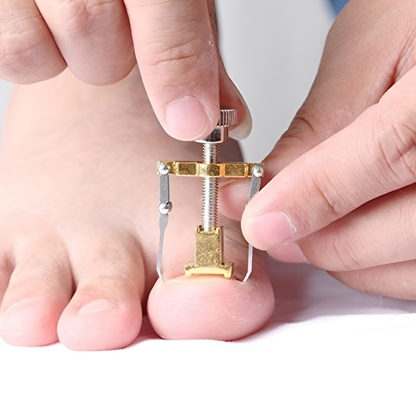 Ingrown Toenail Corrector Tool Stainless Steel Ingrown Toenail Treatment
