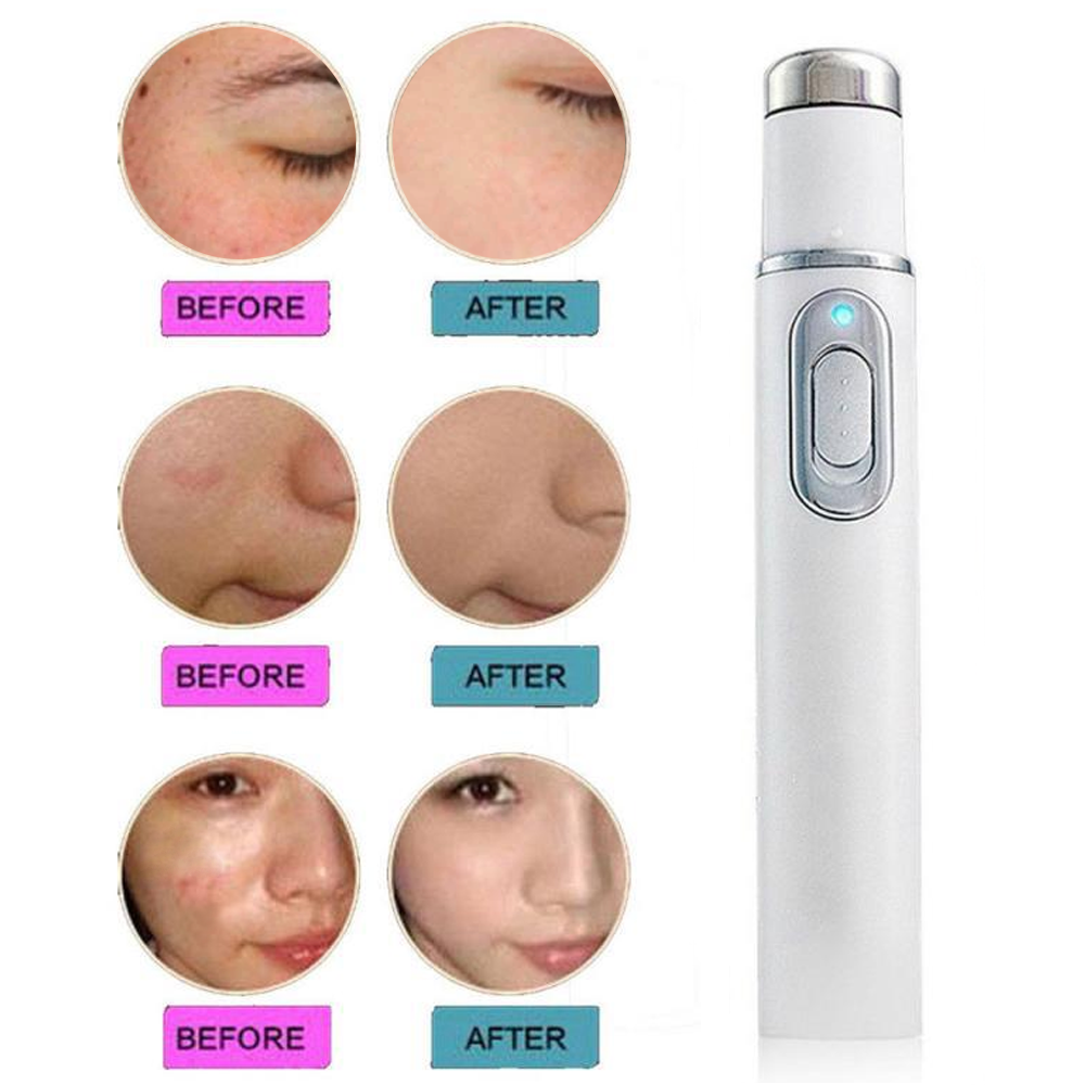acne laser pen