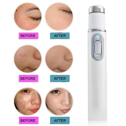 acne laser pen
