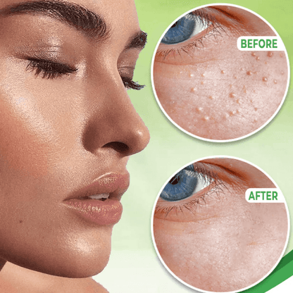 Natural Ingredients in Milia Removal Cream
