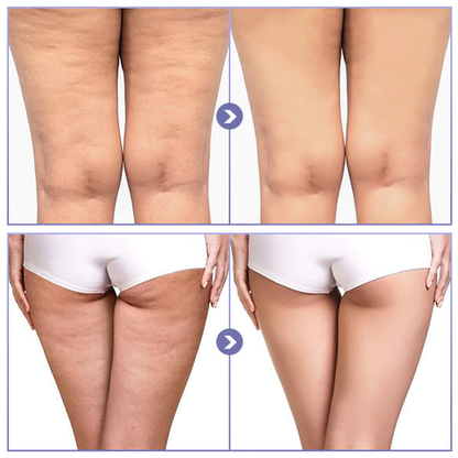 skinniertighteningcellulitereducingthighpatch5png