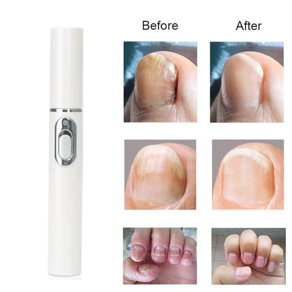antifunguslaser6.png