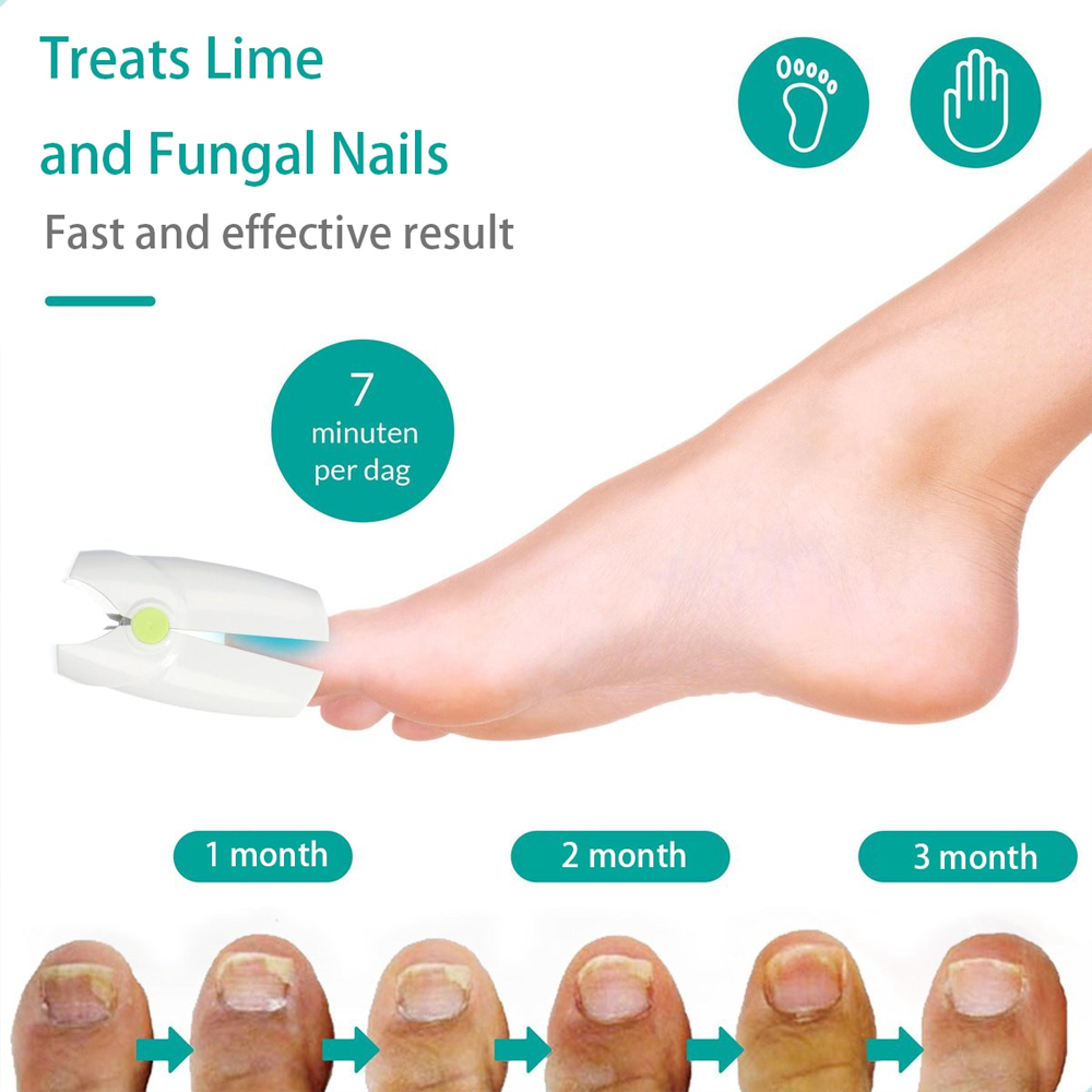 nailfunguslaserdevice6.png