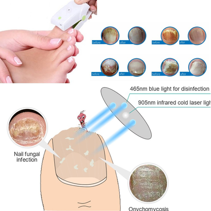 bluelighttherapyfornailfungus5.png