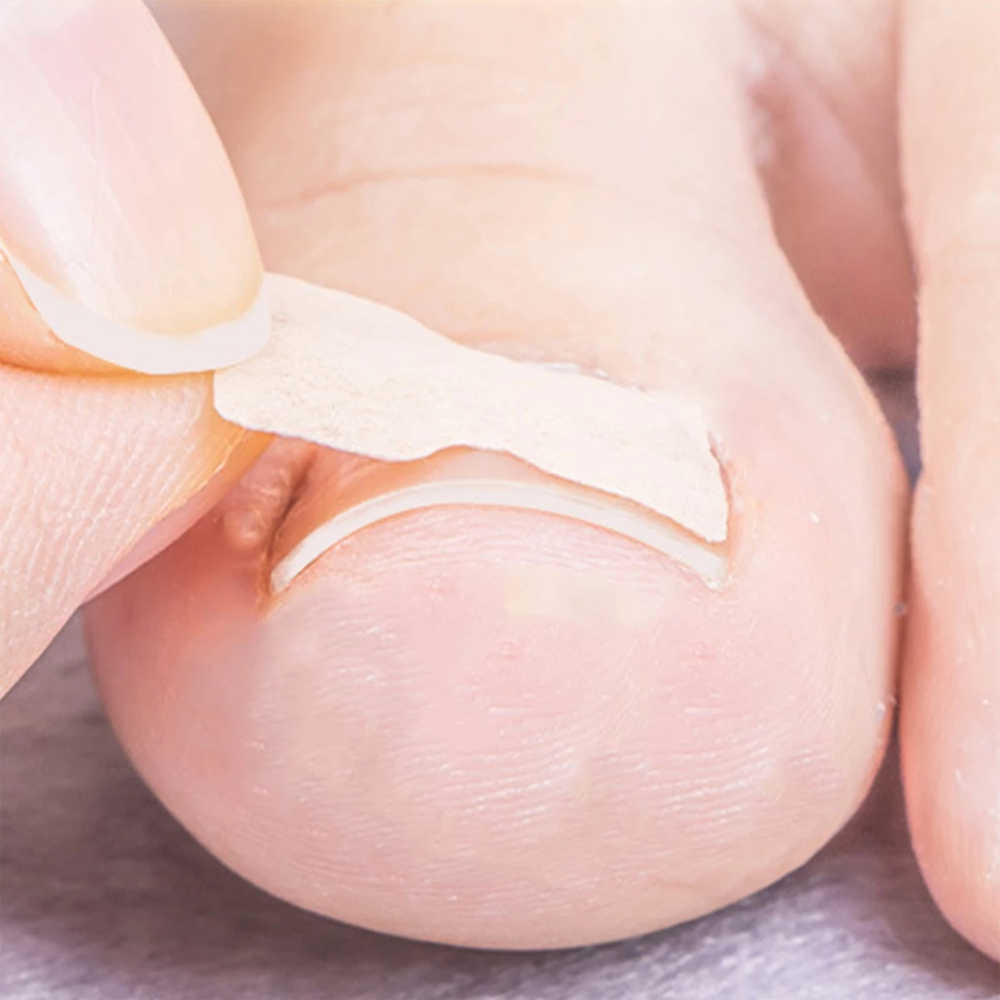 toenail corrector patches