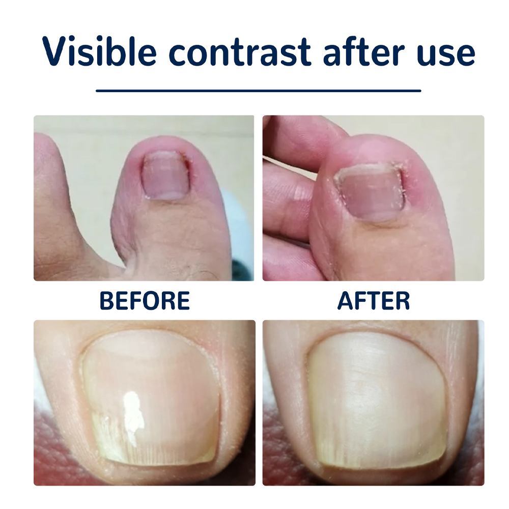 ingrown toenail patches