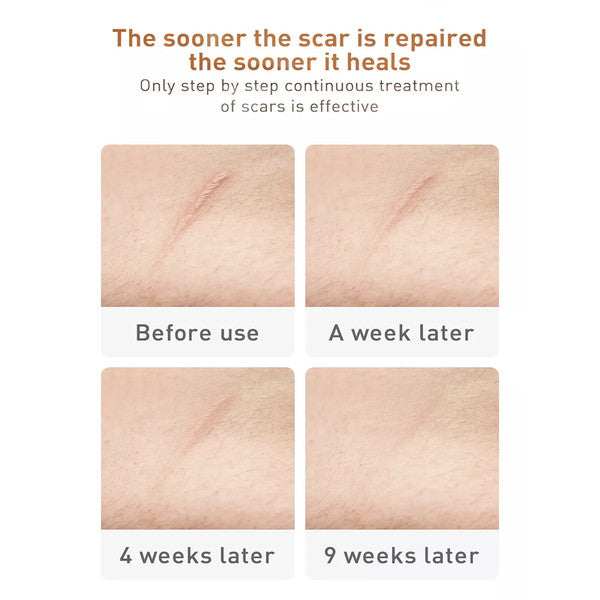 TCM Acne Scar Cream 6