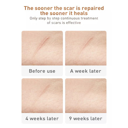 TCM Acne Scar Cream 6