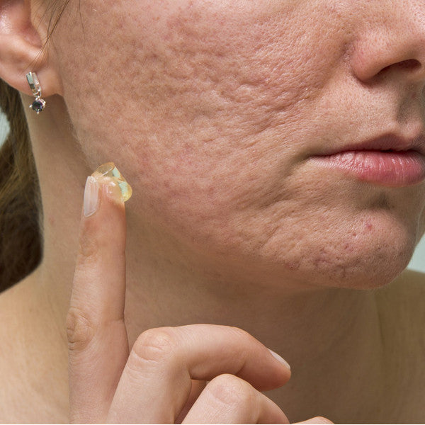 TCM Acne Scar Cream – Natural Herbal Treatment for Clear, Smooth Skin