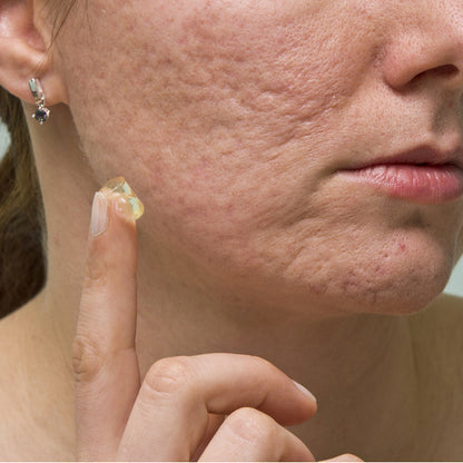 TCM Acne Scar Cream – Natural Herbal Treatment for Clear, Smooth Skin