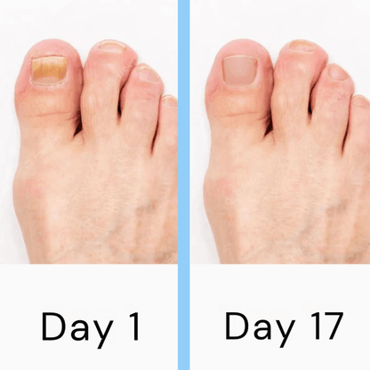 Nail Laser Fungus Device 4