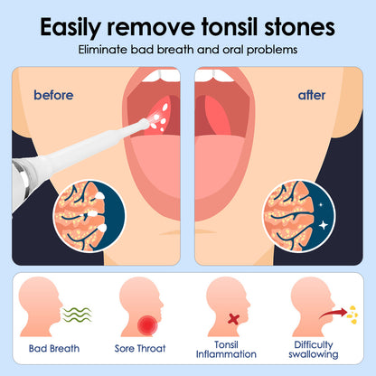 Electric Tonsil Stone Remover Kit, Tonsil Stone Removal Vacuum with LED Light, 3 Suction Modes & Irrigation Syringe