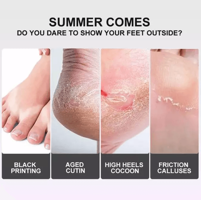 Exfoliating Foot Peel Mask For Baby Soft Feet Callus Remover Socks To Remove Dead Skin  Cracked Hee 4
