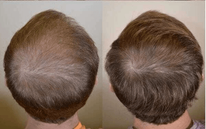 Best Hair Loss Conditioner For Men Women DAROXIL Fast Regrowth Therapy With 16 Organic Oils DHT Blo 4