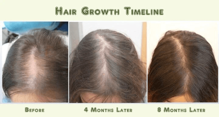Best Hair Loss Conditioner For Men Women DAROXIL Fast Regrowth Therapy With 16 Organic Oils DHT Blo 1