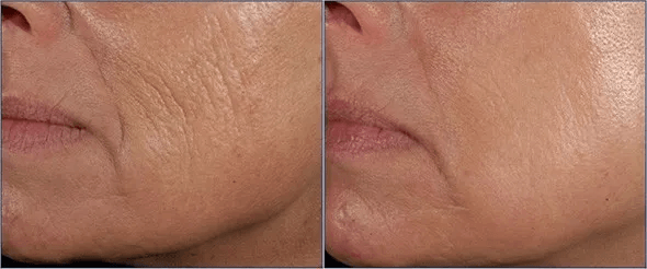 Strongest Anti Aging Wrinkle Cream With Hyaluronic Acid Glycolic Acid Botanical Facial Toner Serum  2
