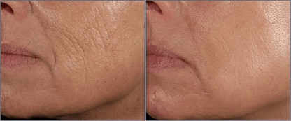 Strongest Anti Aging Wrinkle Cream With Hyaluronic Acid Glycolic Acid Botanical Facial Toner Serum  2