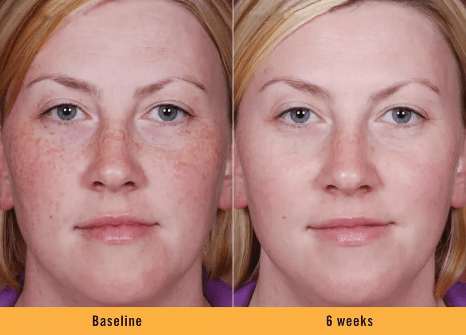 Kojic Acid Skin Whitening Serum Ultra Brightening Dark Spot Corrector With Niacinamide  Vitamin C 1