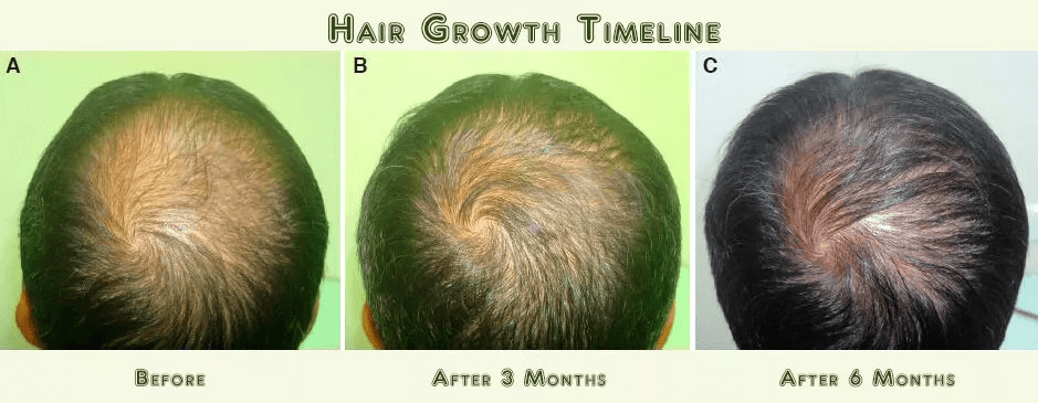Best Fastest Hair Loss ReGrowth AntiThinning Shampoo 16 Organic Oils For Men  Women 1