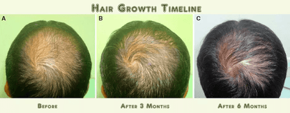 Best Fastest Hair Loss ReGrowth AntiThinning Shampoo 16 Organic Oils For Men  Women 1