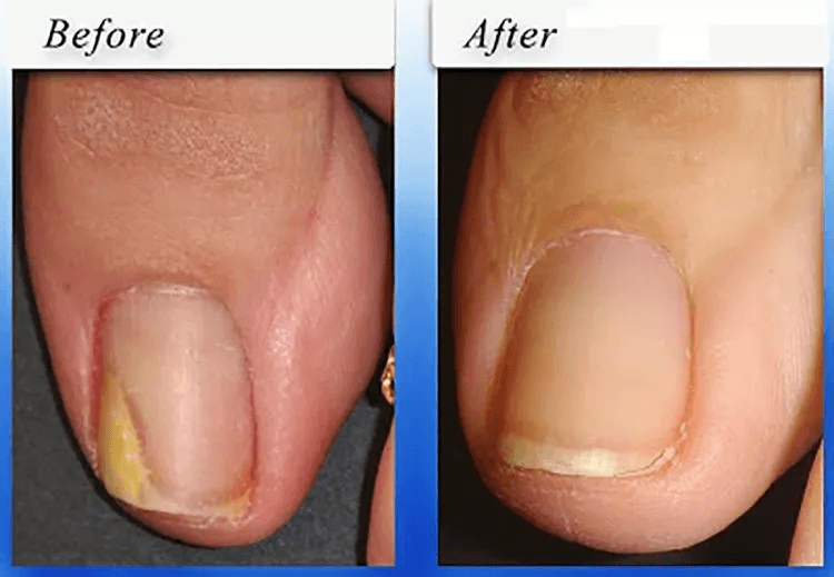 Natural Nail Fungus Treatment Effective Solution For Toe  Finger Nail Infections 3