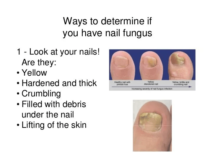 Natural Nail Fungus Treatment Effective Solution For Toe  Finger Nail Infections 1
