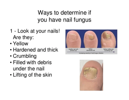 Natural Nail Fungus Treatment Effective Solution For Toe  Finger Nail Infections 1