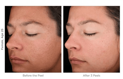 MicroDermabrasion AHA Cream Exfoliant Anti Aging Anti Wrinkle Resurfacing Scrub With Organic Ingred 1