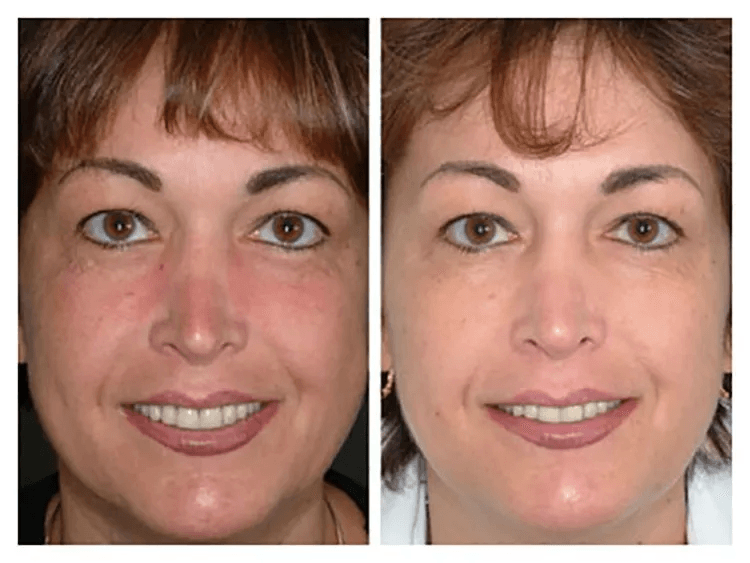 MicroDermabrasion AHA Cream Exfoliant Anti Aging Anti Wrinkle Resurfacing Scrub With Organic Ingred 4