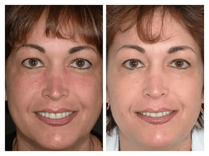 MicroDermabrasion AHA Cream Exfoliant Anti Aging Anti Wrinkle Resurfacing Scrub With Organic Ingred 4