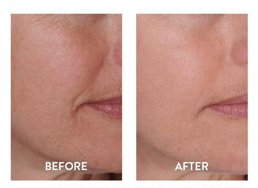 Pure Hyaluronic Acid Serum Anti Aging Hydration For Wrinkle  Fine Line Reduction 3