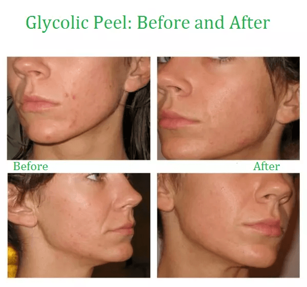 Advanced Glycolic Acid Plus AntiAging Serum Cream Fades Acne Scars Wrinkles  Dark Spots For Youthfu 2