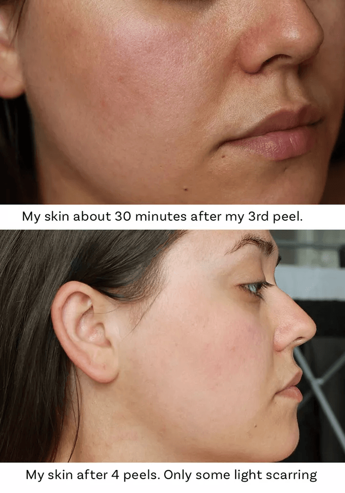 Advanced Glycolic Acid Plus AntiAging Serum Cream Fades Acne Scars Wrinkles  Dark Spots For Youthfu 4