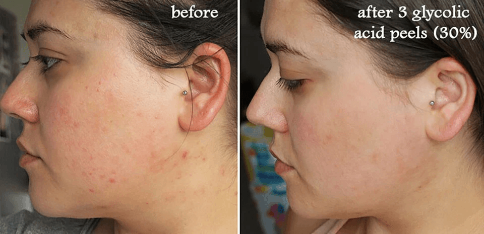 Advanced Glycolic Acid Plus AntiAging Serum Cream Fades Acne Scars Wrinkles  Dark Spots For Youthfu 3