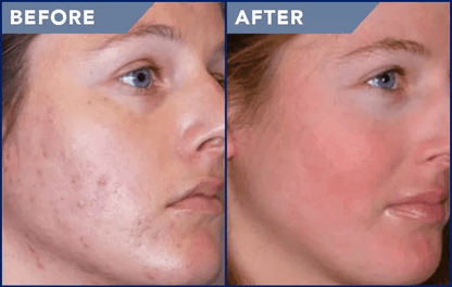 Professional MicroDermabrasion Cloth Reduce Wrinkles Acne Scars And Cellulite DermaSPA Terry Weave  1
