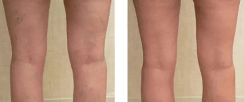 Vitamin K Cream Maximum Strength Skin Repair Spider Vein Varicose Vein Bruise Treatment For All Ski 5