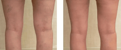 Vitamin K Cream Maximum Strength Skin Repair Spider Vein Varicose Vein Bruise Treatment For All Ski 5