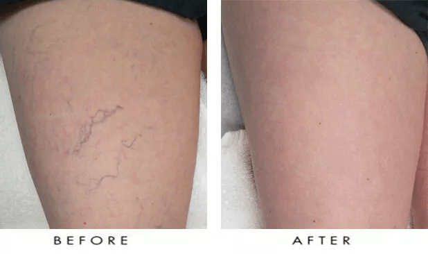 Vitamin K Cream Maximum Strength Skin Repair Spider Vein Varicose Vein Bruise Treatment For All Ski 6
