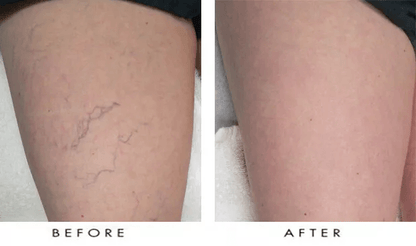 Vitamin K Cream Maximum Strength Skin Repair Spider Vein Varicose Vein Bruise Treatment For All Ski 6