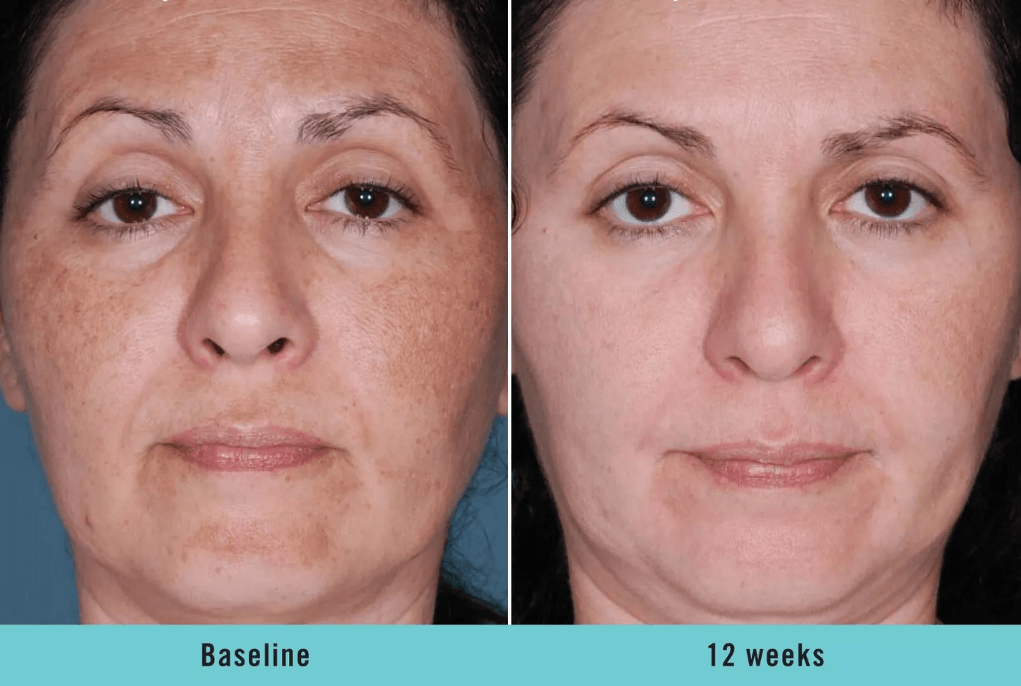 KOJIC ACID Skin Whitening Face Brightening Serum Dark Spot Remover With Alpha ArbutinVitamin C Mela 3