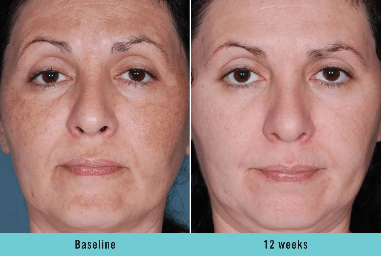 KOJIC ACID Skin Whitening Face Brightening Serum Dark Spot Remover With Alpha ArbutinVitamin C Mela 3