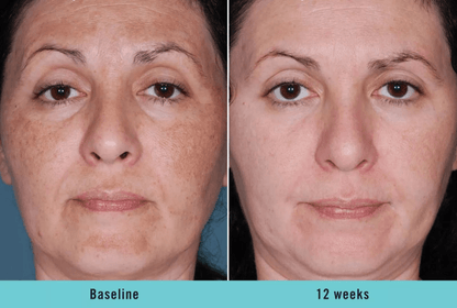 KOJIC ACID Skin Whitening Face Brightening Serum Dark Spot Remover With Alpha ArbutinVitamin C Mela 3
