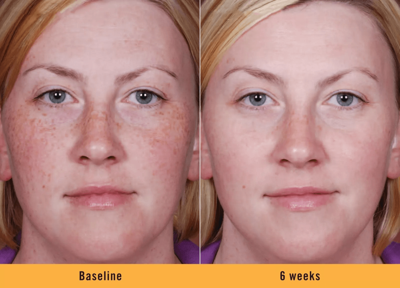 KOJIC ACID Skin Whitening Face Brightening Serum Dark Spot Remover With Alpha ArbutinVitamin C Mela 4