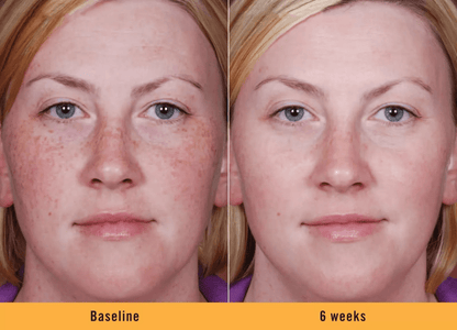 KOJIC ACID Skin Whitening Face Brightening Serum Dark Spot Remover With Alpha ArbutinVitamin C Mela 4