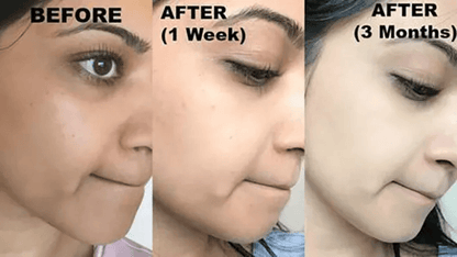 KOJIC ACID Skin Whitening Face Brightening Serum Dark Spot Remover With Alpha ArbutinVitamin C Mela 2