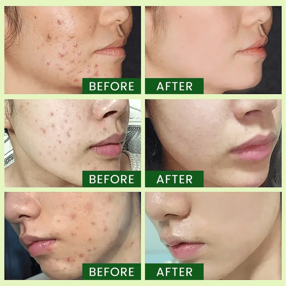Tea Tree Serum Pure Niacinamide B3 Salicylic Hyaluronic Acid VC Organic Acne Treatment For Clear Ra 1