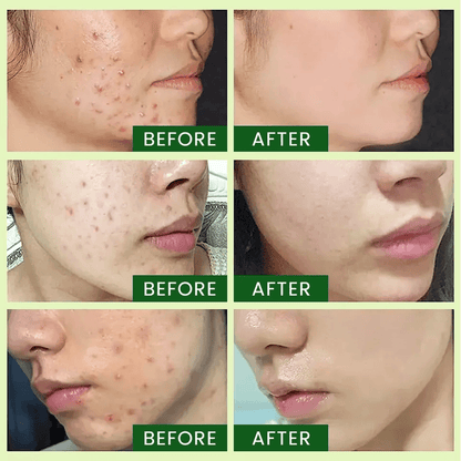 Tea Tree Serum Pure Niacinamide B3 Salicylic Hyaluronic Acid VC Organic Acne Treatment For Clear Ra 1
