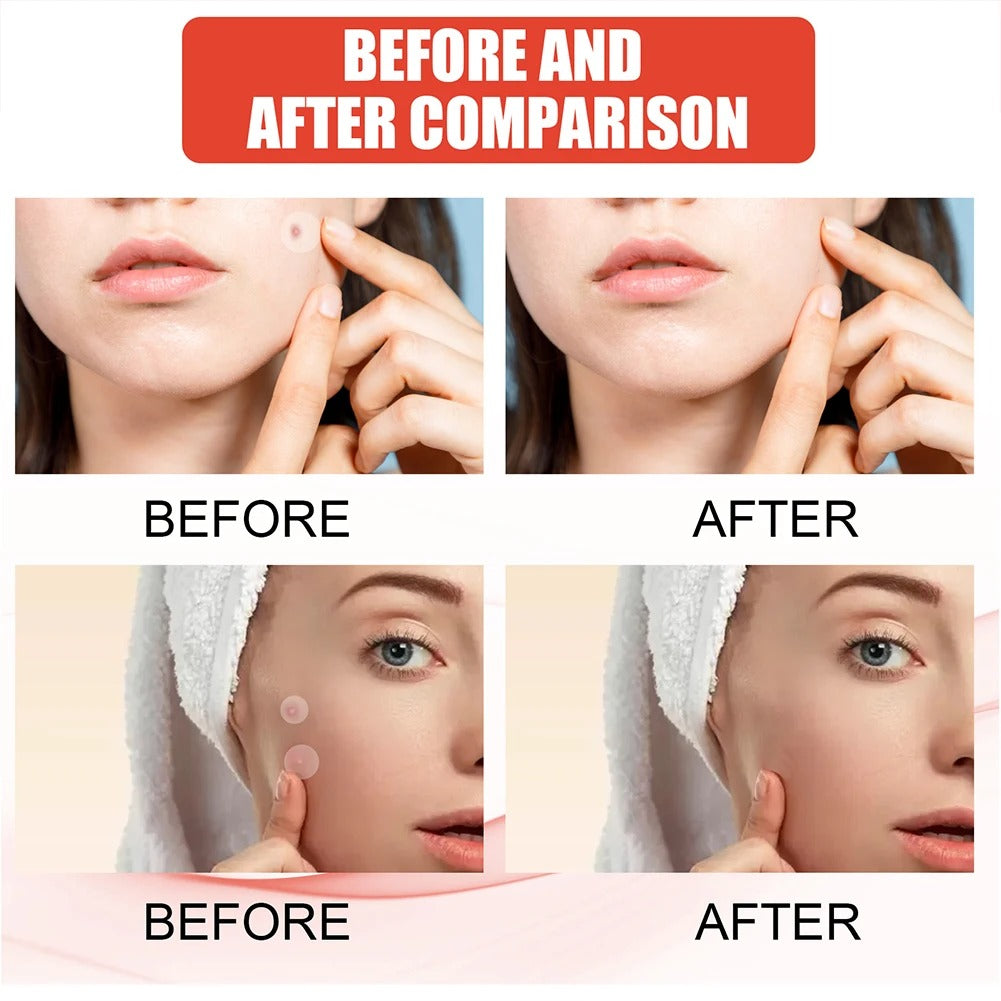 Professional Acne Patches, High-End Skin Care Pimple Stickers for Healing & Absorbing Spots