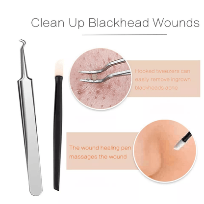 Blackhead Remover Kit Stainless Steel Pimple Popper Tools Comedone Extractor Set For Acne Zit White 3